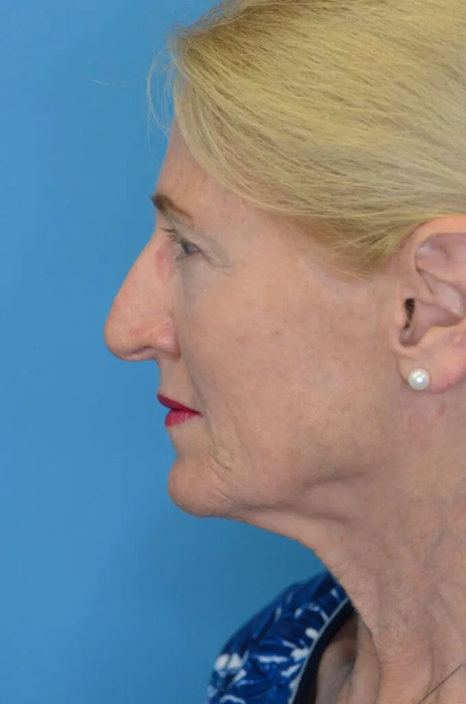 Patient NC before surgical procedure, from a left lateral view