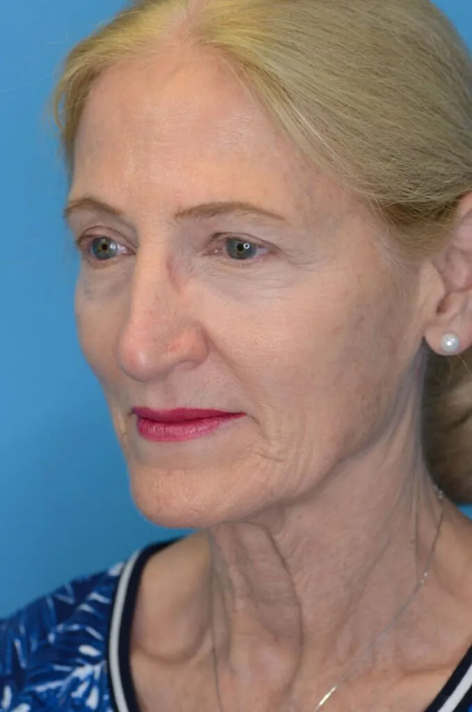 Patient NC before surgical procedure, from a left oblique view