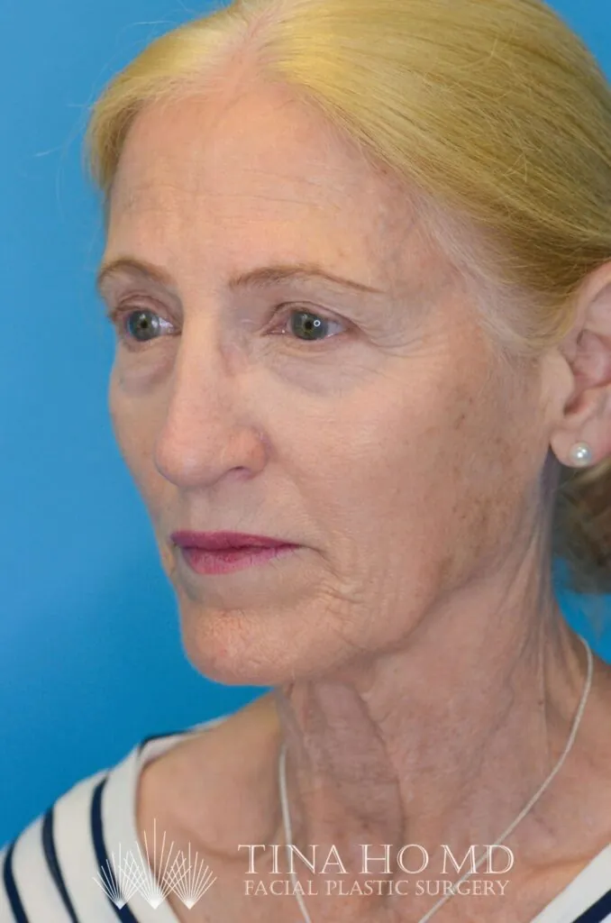 Patient NC after surgical procedure, from a left oblique view