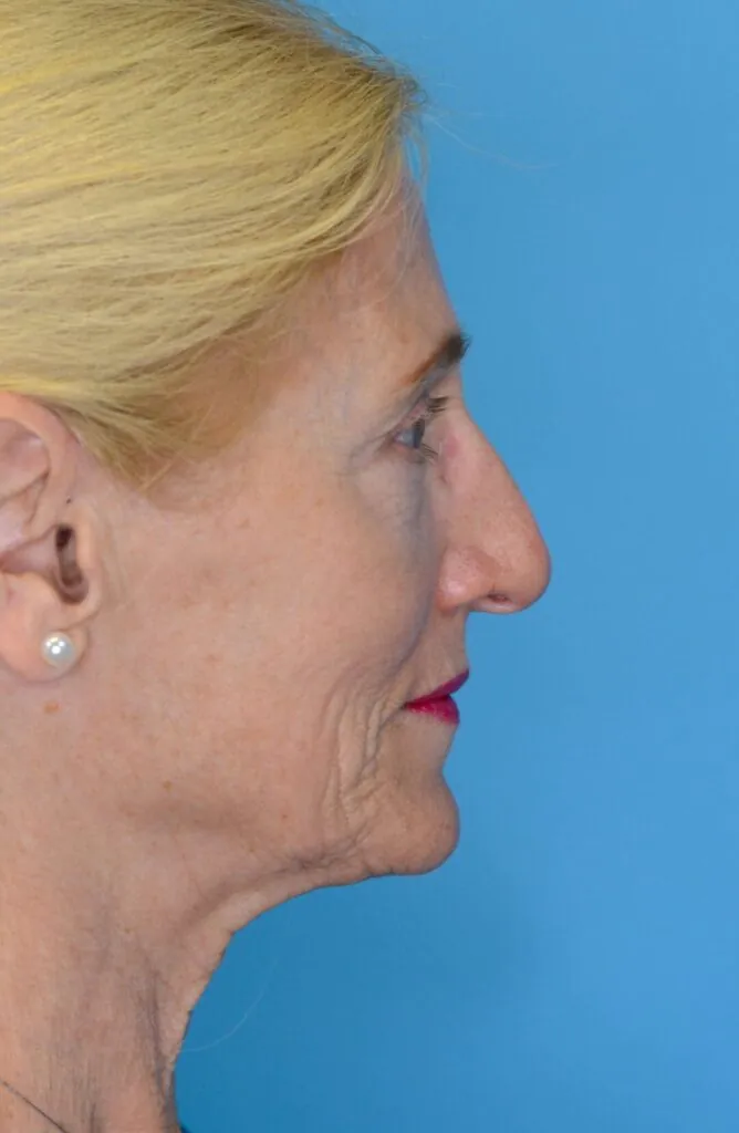 Patient NC before surgical procedure, from a right lateral view