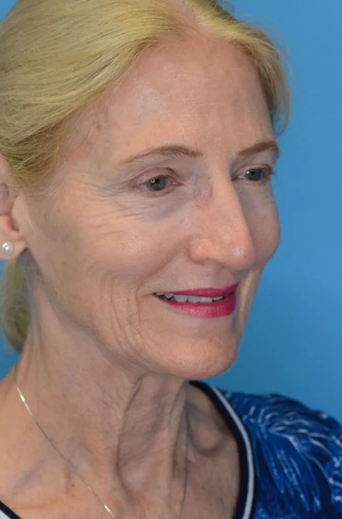 Patient NC before surgical procedure, from a right oblique view