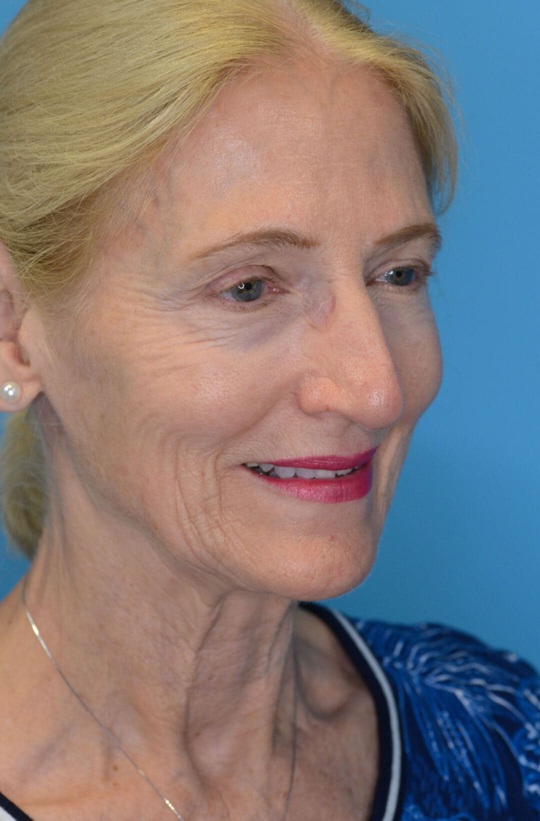 Patient NC before surgical procedure, from a right oblique view