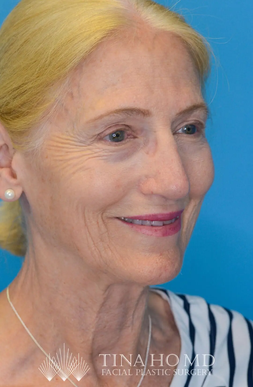 Patient NC after surgical procedure, from a right oblique view