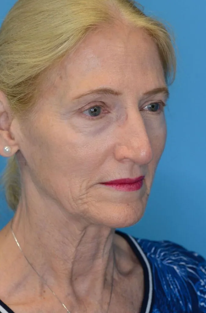 Patient NC's right oblique view before rhinoplasty surgery