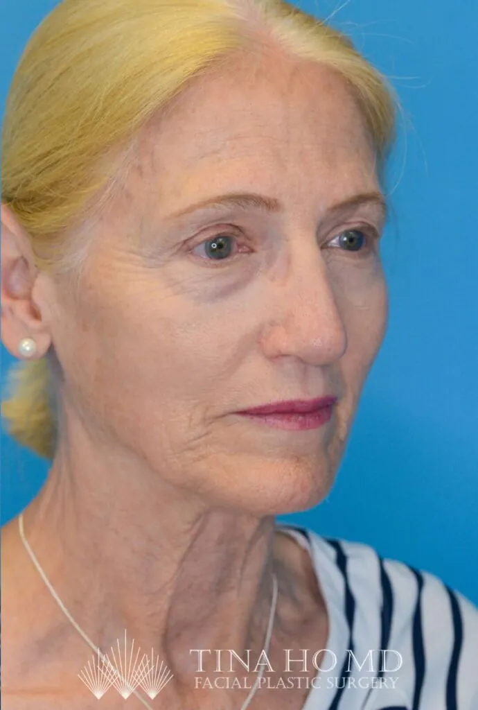 Patient NC's improved right oblique view after rhinoplasty