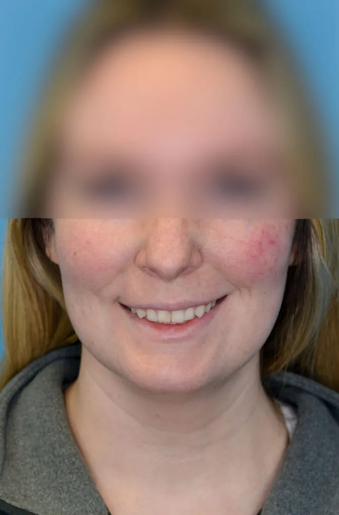 Person's frontal view before neck lift showing signs of aging neck