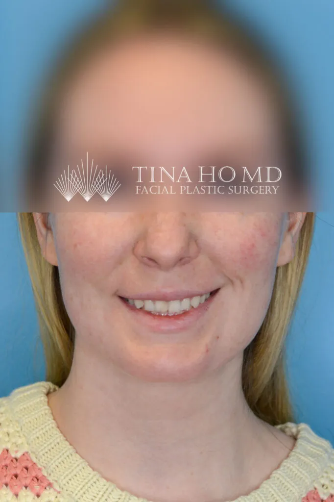 Person's frontal view after neck lift showing a more youthful neck