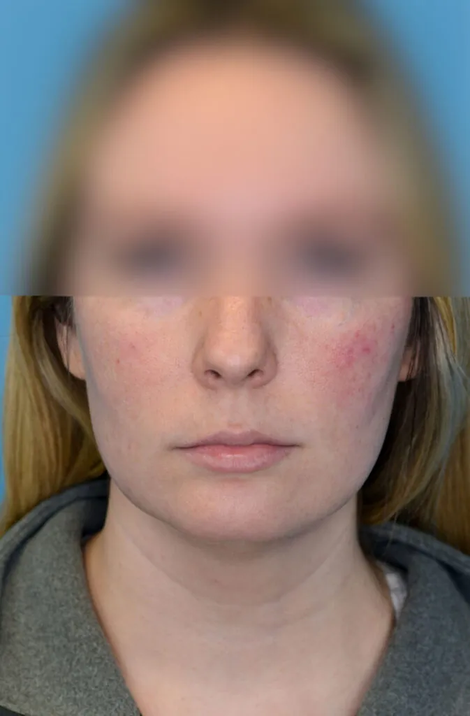 Person's frontal view before neck lift showing loose skin and wrinkles