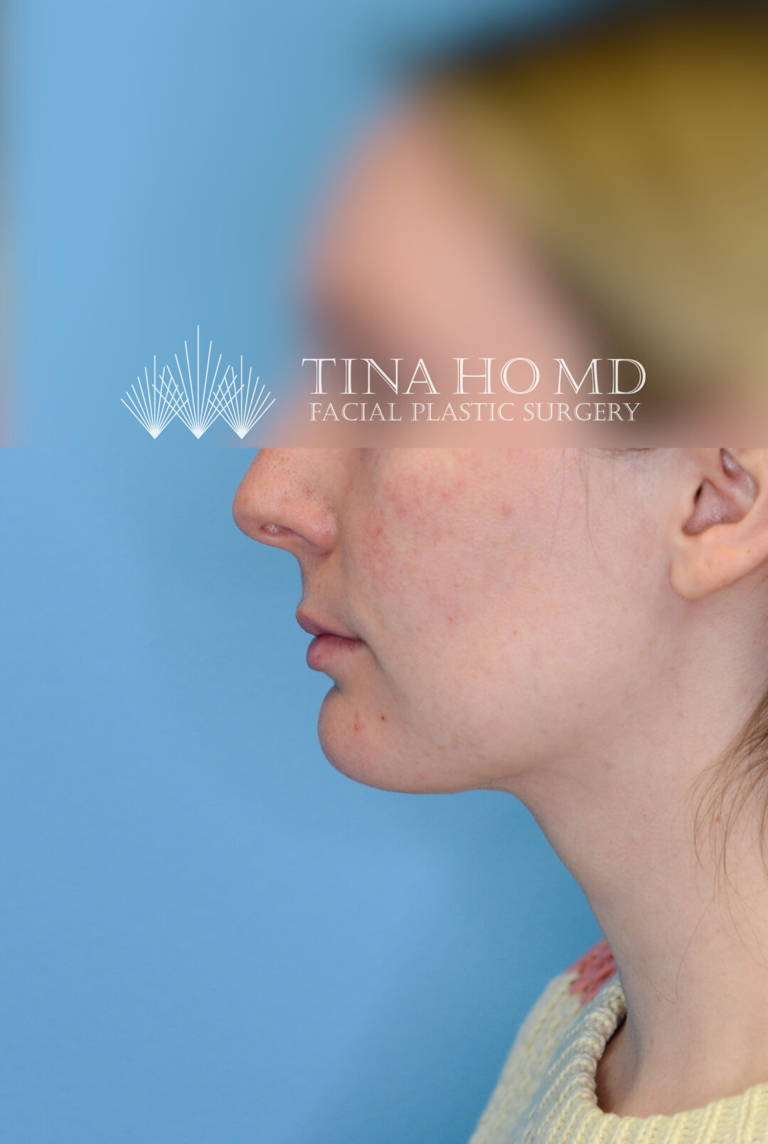 Person's left profile after neck lift with improved jawline and neck definition