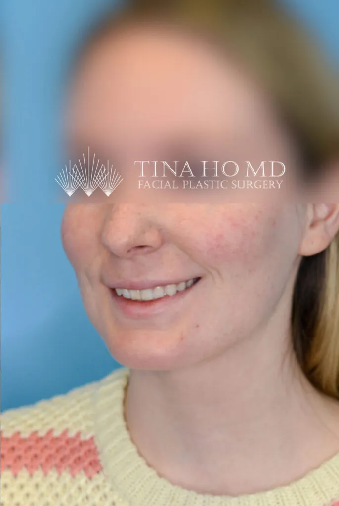 Person's left oblique view after neck lift with reduced neck fullness