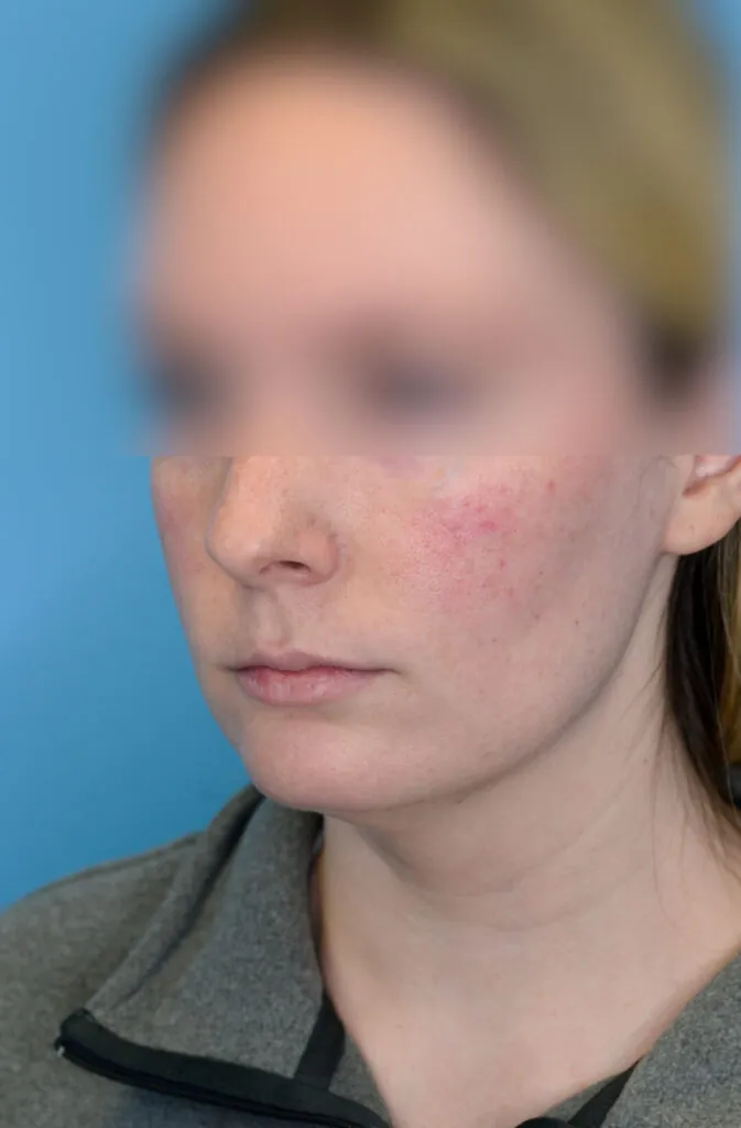 Person's left oblique view before neck lift showing loose skin under chin