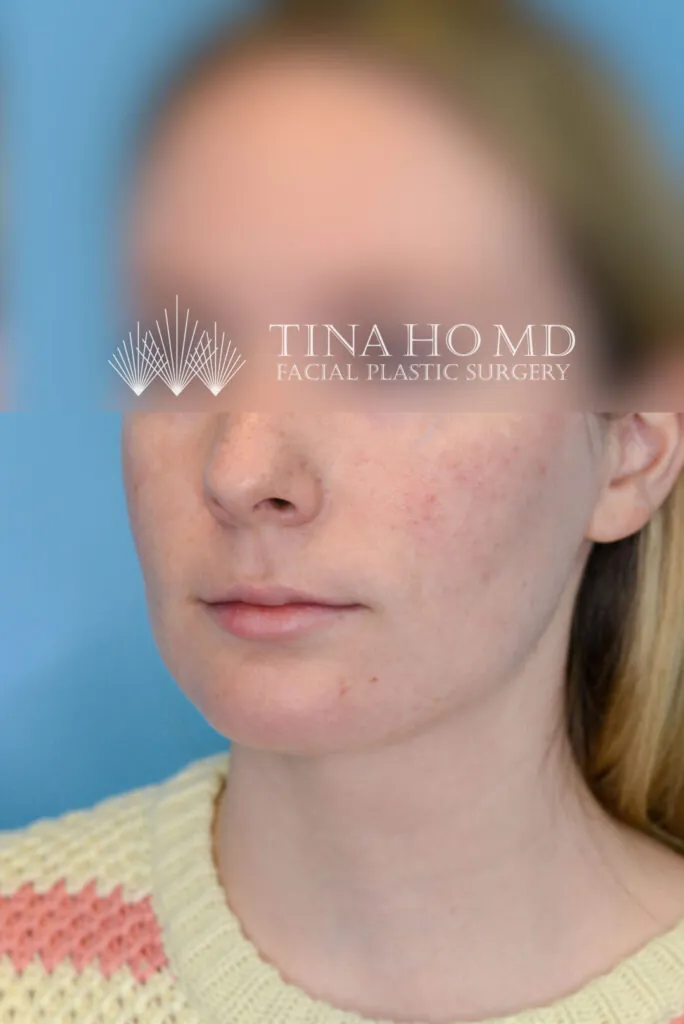 Person's left oblique view after neck lift with improved chin and jawline