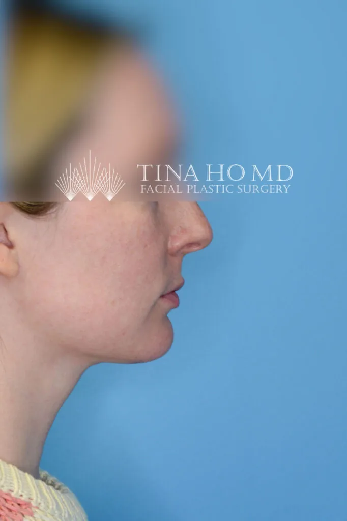 Person's right profile after neck lift with a firmer, more defined jawline