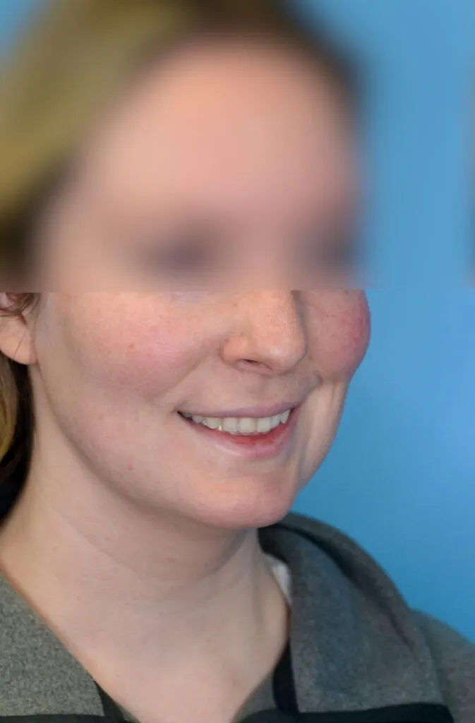 Patient RW before surgical procedure, second right oblique view