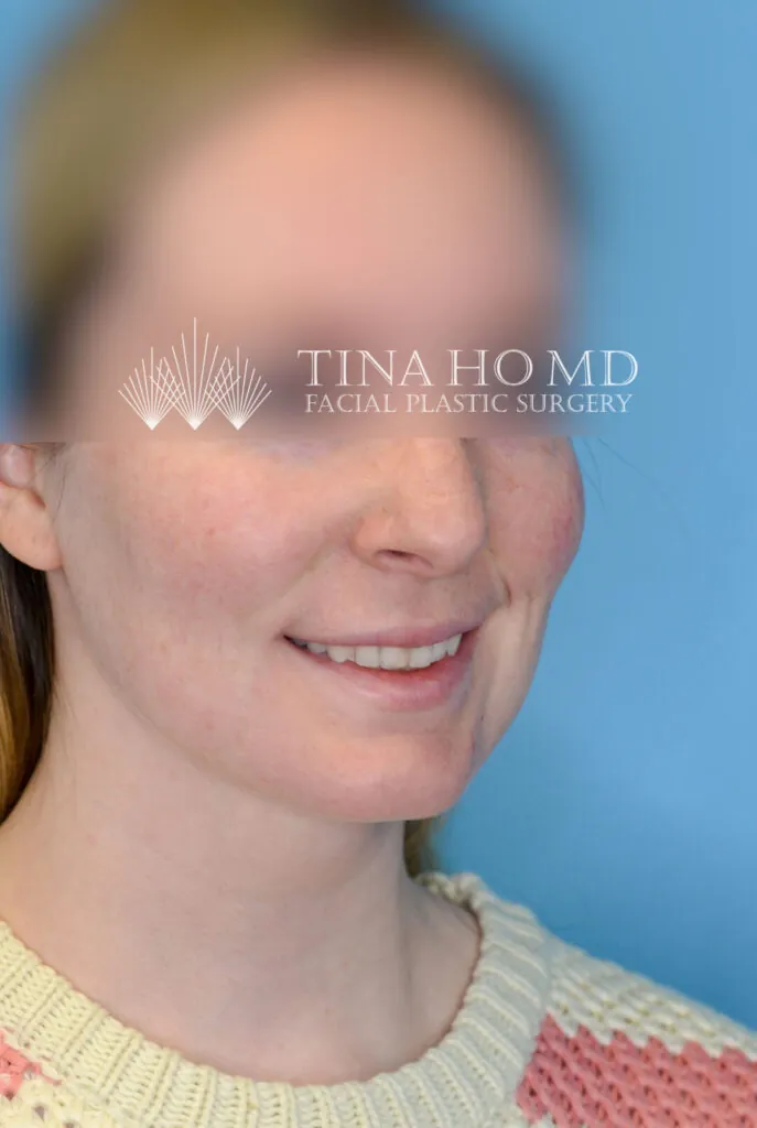 Patient RW after surgical procedure, second right oblique view