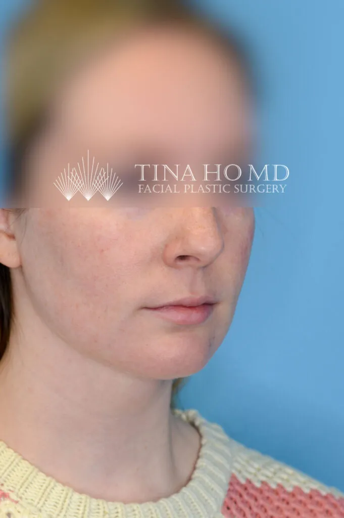 Person's right oblique view after neck lift with a more sculpted jawline