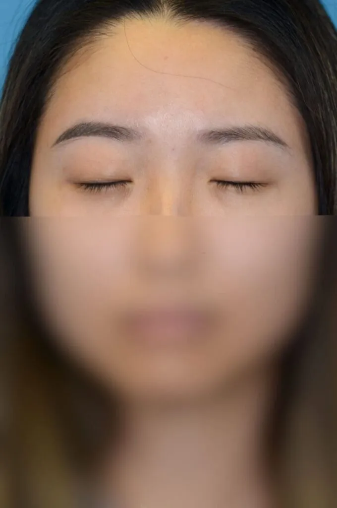 Patient's frontal facial view for blepharoplasty evaluation