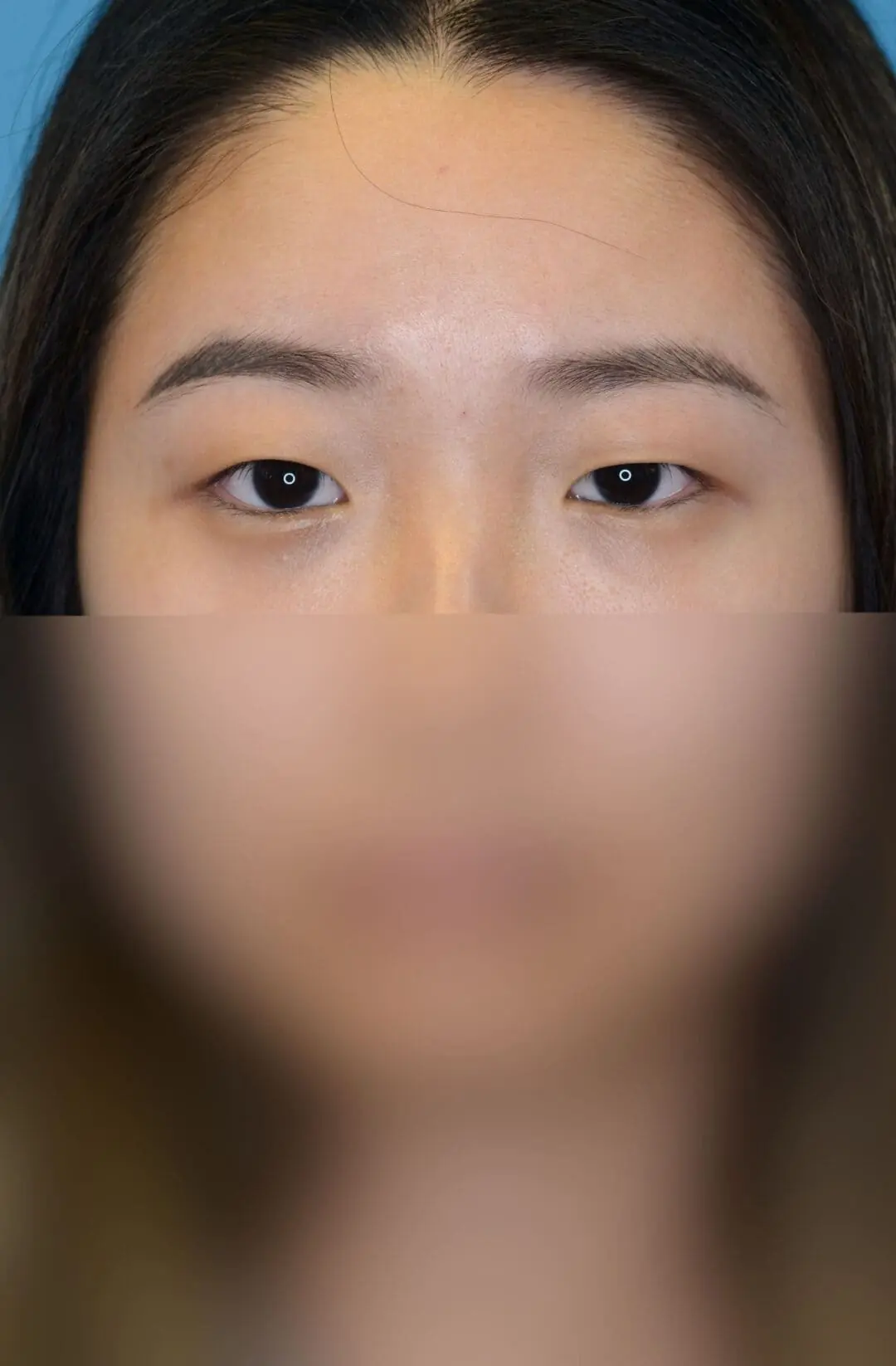 Patient's frontal facial view before upper blepharoplasty in Philadelphia