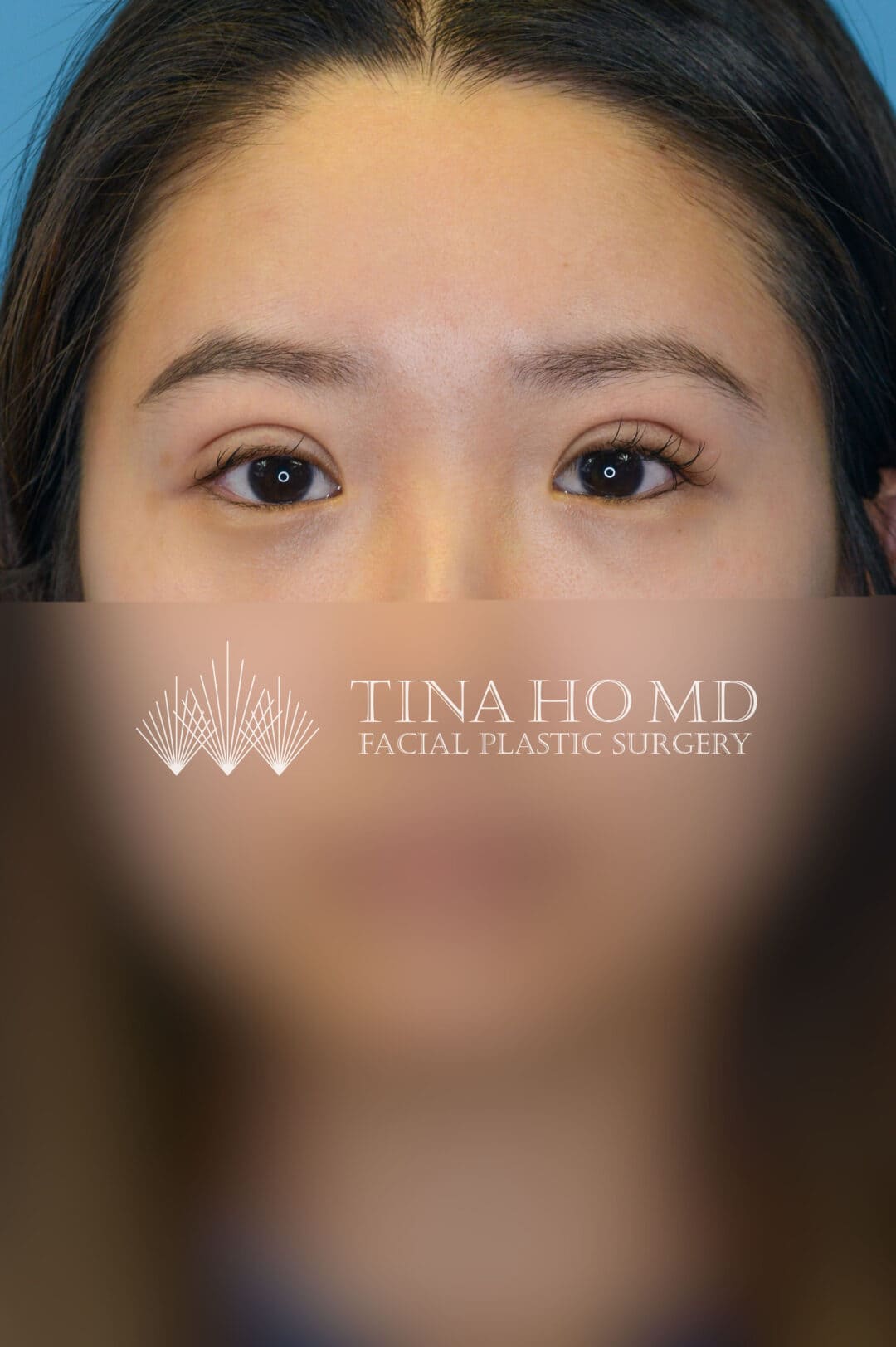 Patient's frontal facial view after upper blepharoplasty in Philadelphia