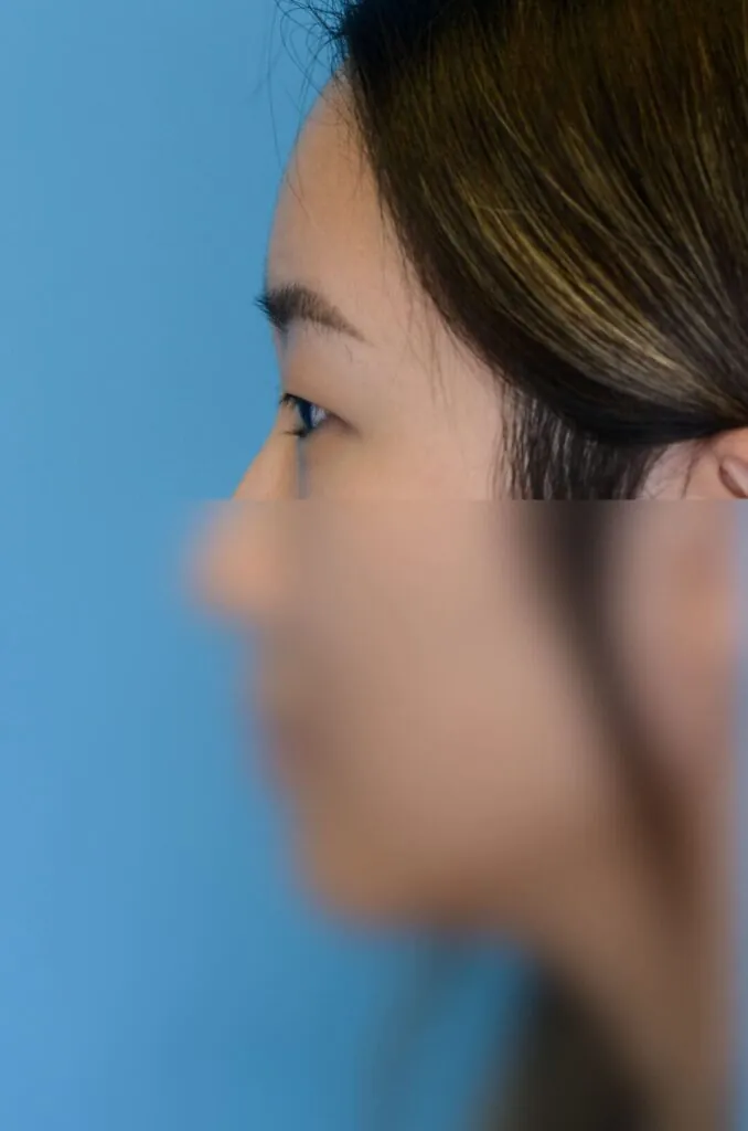 Patient's left lateral facial view for blepharoplasty evaluation