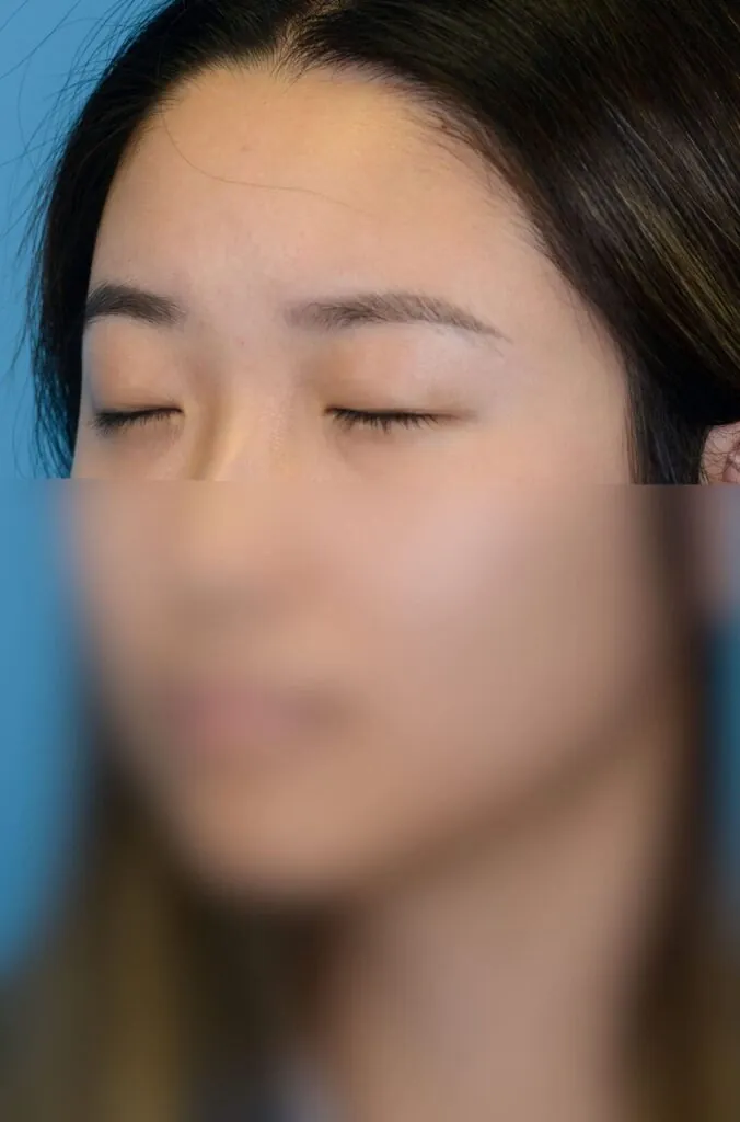 Patient's left oblique facial view for blepharoplasty evaluation