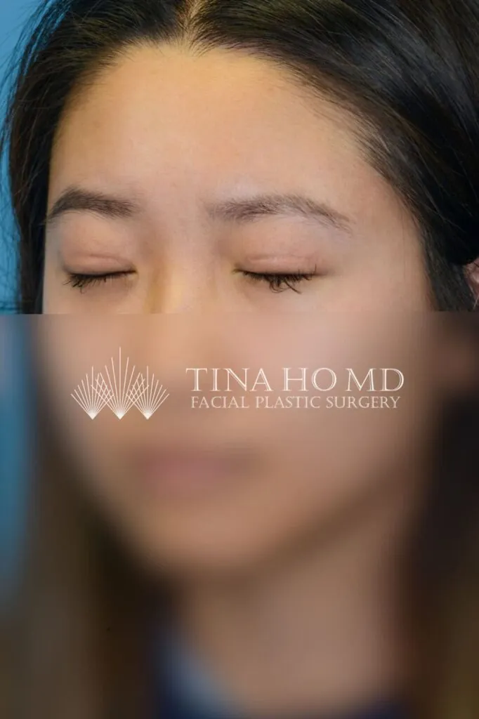 Patient's left oblique facial view after upper blepharoplasty in Philadelphia