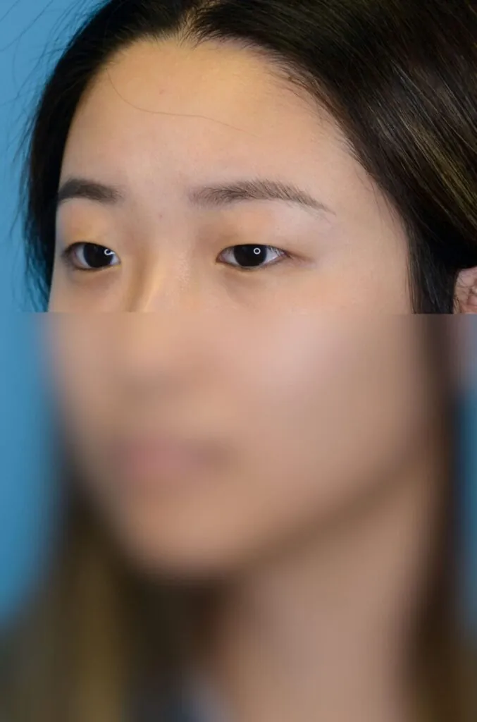 Patient's left oblique facial view for blepharoplasty evaluation