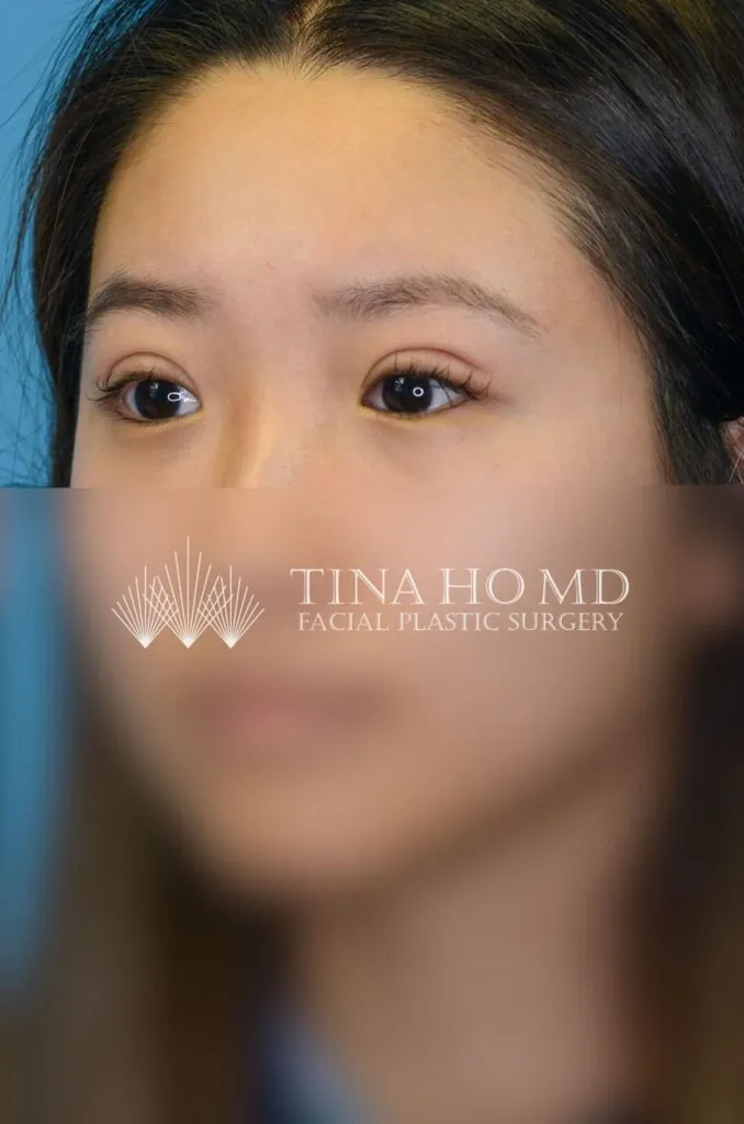 Patient's left oblique facial view after upper blepharoplasty in Philadelphia
