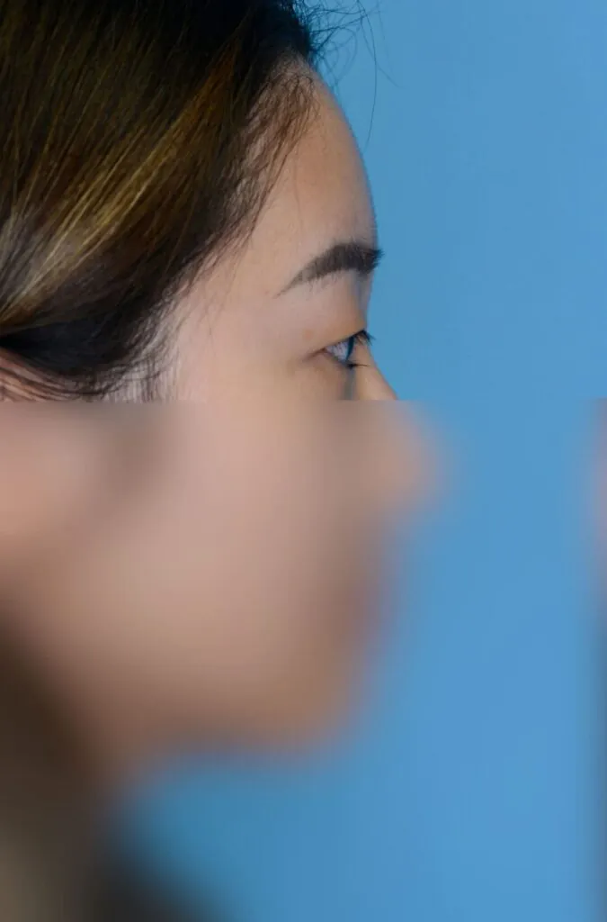 Patient's right lateral facial view for blepharoplasty evaluation