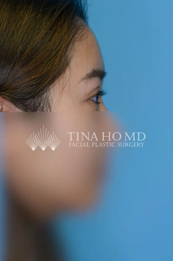 Patient's right lateral facial view after upper blepharoplasty in Philadelphia
