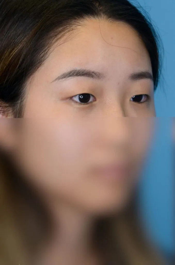 Patient SL right oblique view before upper blepharoplasty in Philadelphia