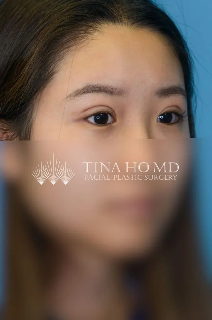 Patient SL right oblique view after upper blepharoplasty in Philadelphia