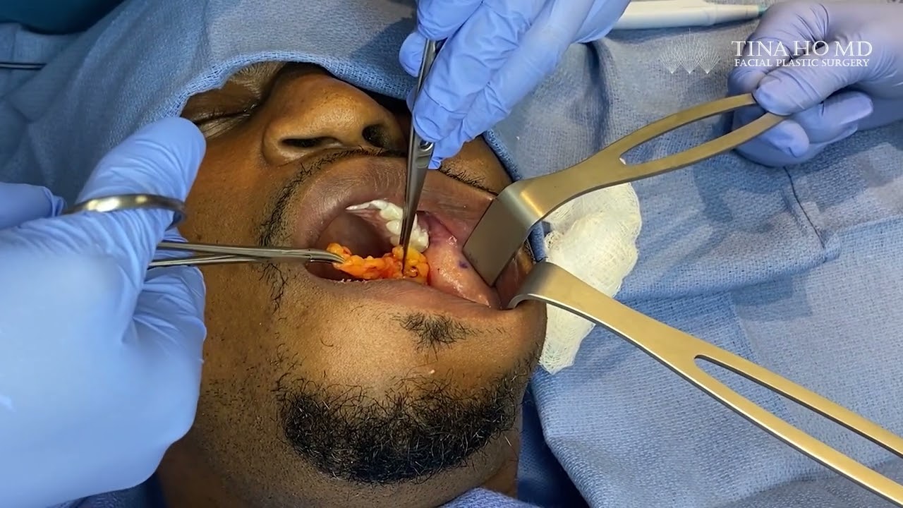Surgeon performs buccal fat removal on a patient.