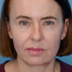 MBfrontal(web) copy