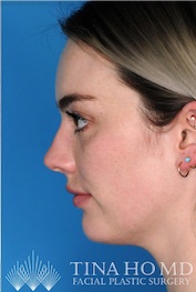 Left Lateral Example