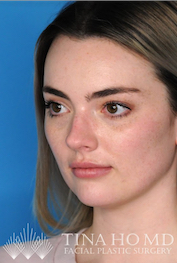 Left Oblique Example