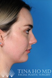 Right Lateral Example