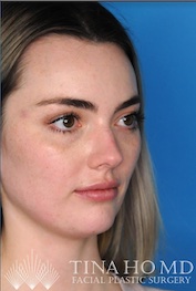 Right Oblique Example