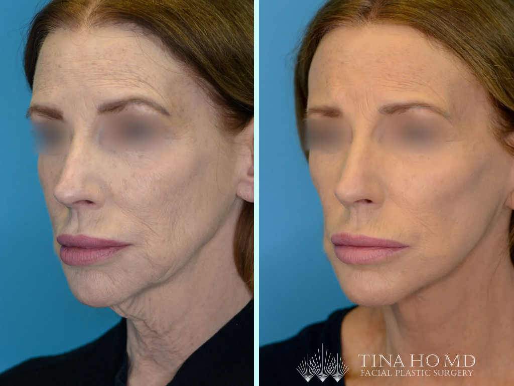 Before and after photos of a patient who underwent a facelift, neck lift, and brow lift.