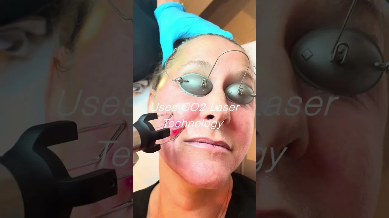 5 Things To Know About CoolPeel CO2 Laser