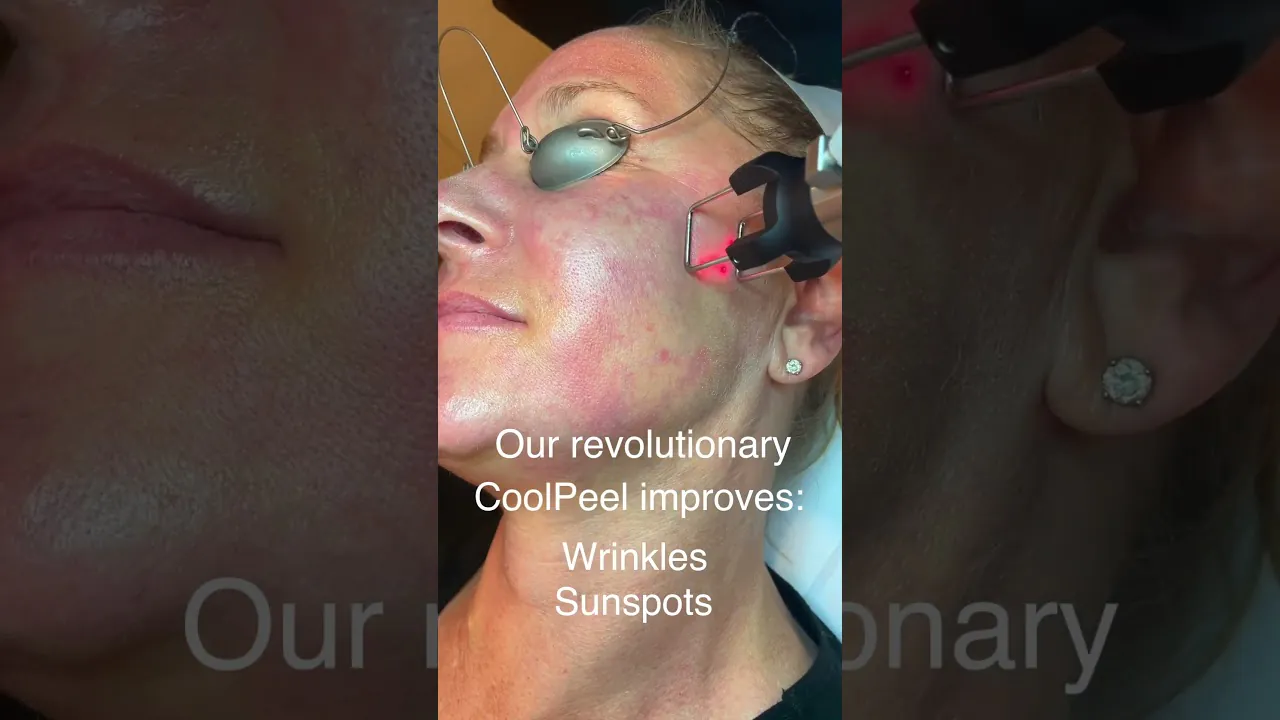CoolPeel Laser!