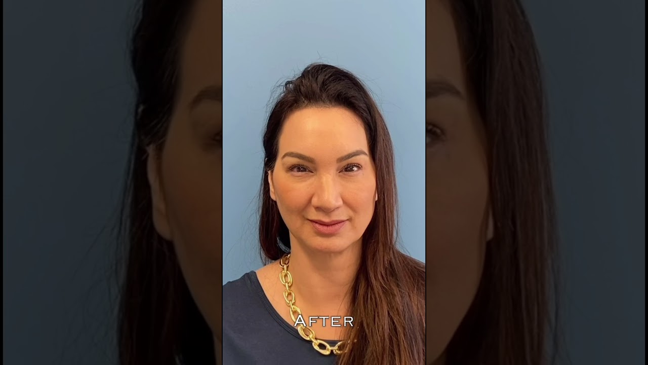 Eyelid Lift: Before and After