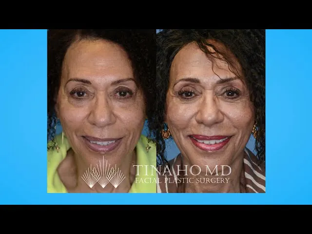 My Experience Having Upper and Lower Eyelid Surgery with Dr. Tina Ho