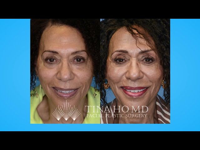 My Experience Having Upper and Lower Eyelid Surgery with Dr. Tina Ho