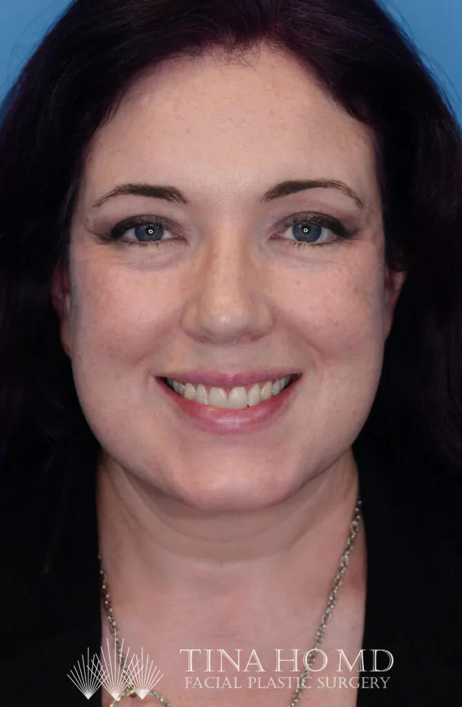 Smiling woman featuring text for Tina Ho MD facial plastic surgery.