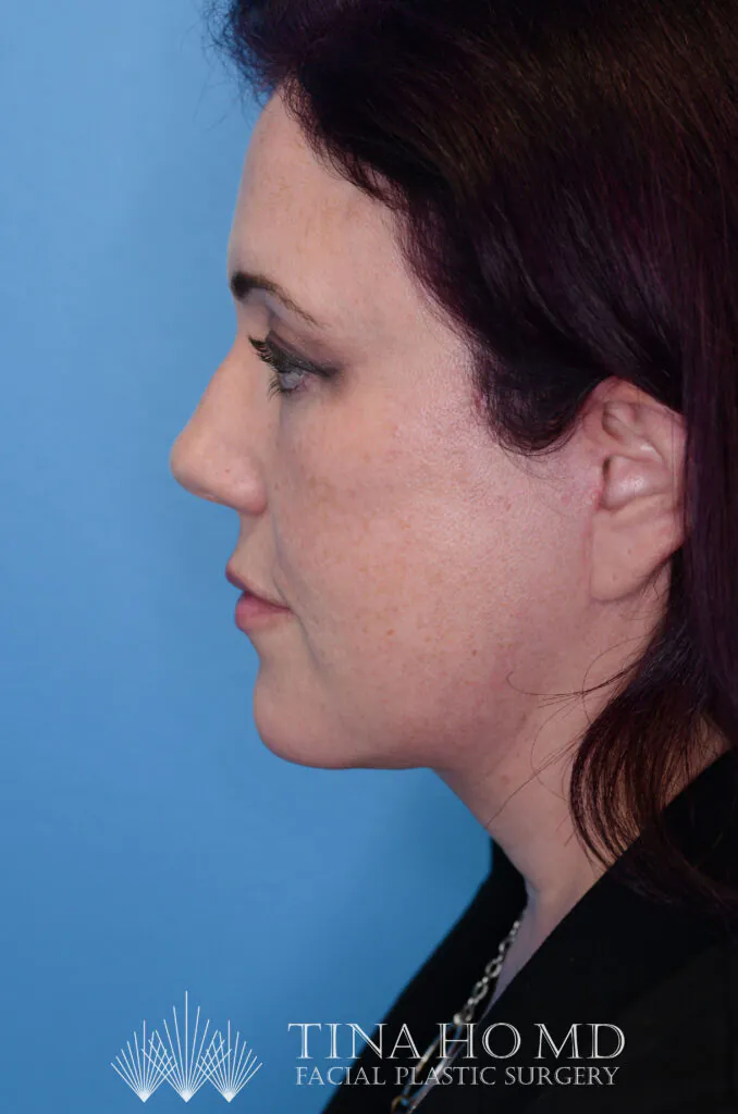 Woman shown in profile view against a blue background.