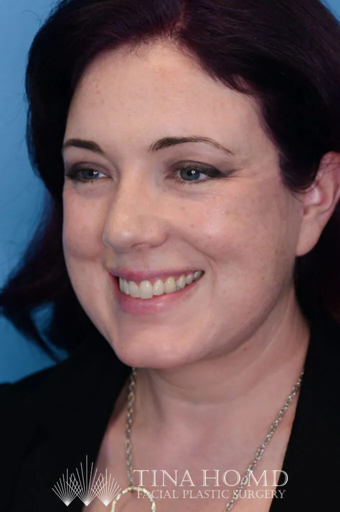 Smiling woman poses for a Tina Homd Facial Plastic Surgery portrait.