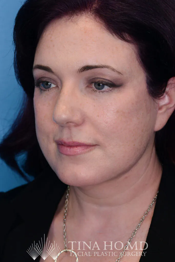 Woman posing for a facial plastic surgery portrait.