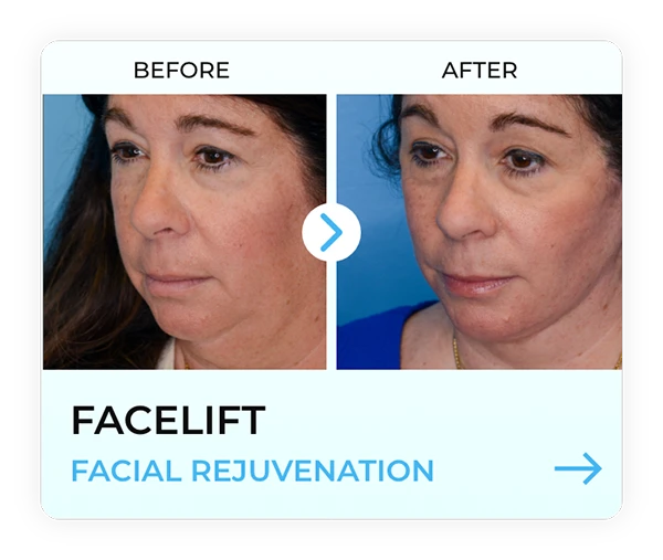 A woman shown before and after facial rejuvenation surgery.