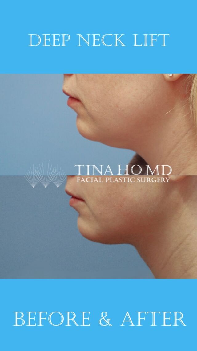 Deep Neck Lift: Before and After
Thuy-Van Tina Ho, MD

This lovely patient in her early 30s came to me for surgical consultation, bothered by the fullness under her chin and lack of jawline definition. She initially believed she was a chin liposuction candidate; however, based on her neck anatomy characterized by muscle laxity and bulky deeper fat and muscle, this patient was better suited for neck lift surgery. We pursued a deep neck lift to restore a more youthful contour to her jawline and neck. We are so thrilled with her beautiful, natural results. 

Empowering patients with beautiful, natural results.
Call or visit my website to schedule your neck lift consultation.

Thuy-Van Tina Ho, MD
Philadelphia’s Female Facial Plastic Surgeon
Double Board-Certified
Facial & Jawline Contouring Expert
www.drtinaho.com | 610.688.3363
Wayne @phillyfacialplastics 
Philadelphia @centercityderm 

#philadelphiaplasticsurgery #philadelphia #facialplasticsurgeon #facialplasticsurgery #femaleplasticsurgeon #drtinaho #femalesurgeon #womenempoweringwomen #phillybotox #phillybeauty #bestofphilly #mainlinepa #mainlinemoms #waynepa #phillyfacialplastics

#phillystyle #transformationthursday #beforeandafter #instabeauty #jawlinecontouring #facialcontouring #jawlinegoals #snatchedjawline #facelift #nonsurgicalfacelift #mininecklift #chinlipo #deepnecklift #neckliftbeforeandafter #facialrejuvenation